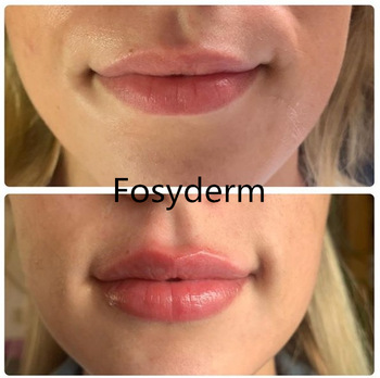 CE Certificate Hyaluronic Acid Cross Linked Dermal Filler For Fuller Lips