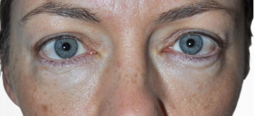 Stalidearm Original Brand Anti Aging Meso Youth Serum Injection Tighten Nourish Natural Organic Instant Face Lift meso