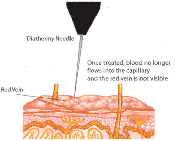 Spider vein laser removal Laser varicose vein removal treatment