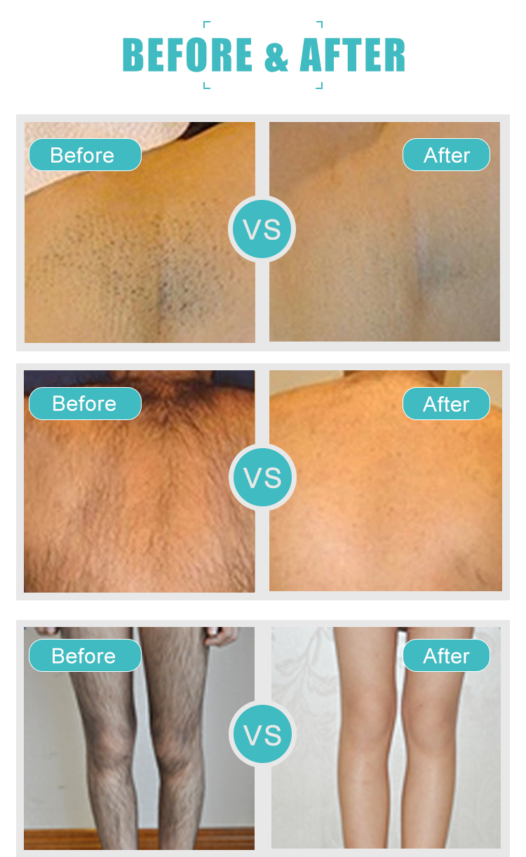 Hair Removal Diode Triple Wavelength Laser , 808 755 1064 Alexandrite Laser Machine