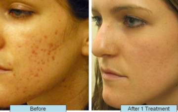CO2 Laser Fractional Skin Resurfacing Treatment
