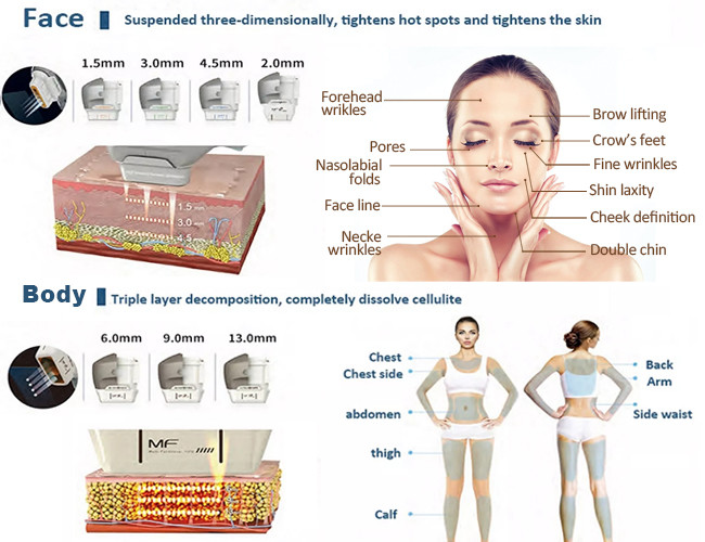 25mm HIFU Slimming Machine 3d Portable Hifu Ultrasound Facelift
