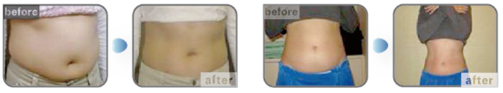 Most popular! best professional Japan cooling pads best effective cryolipolysis cool technology fat freezing machine