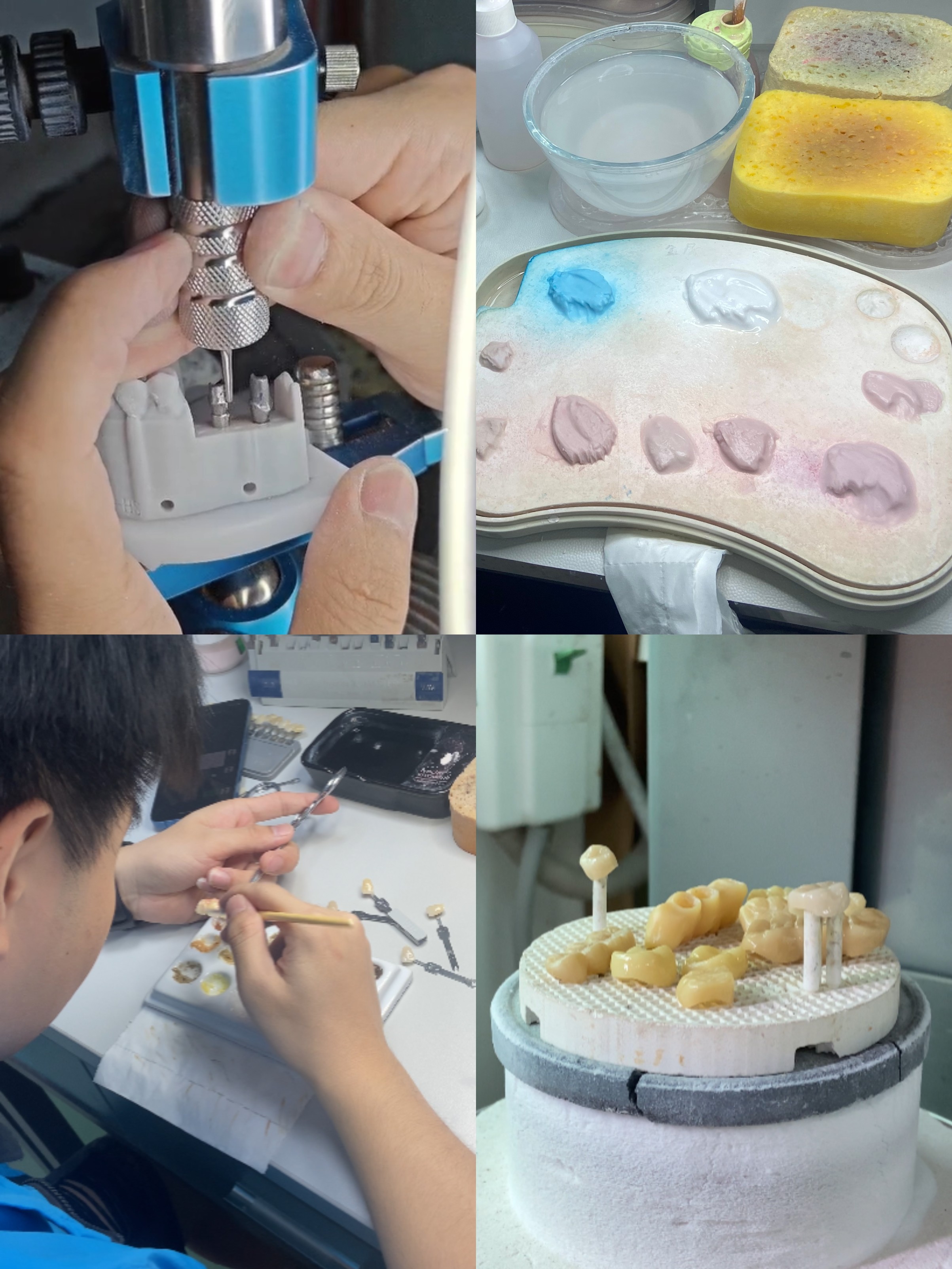 Customizable Polished Dental Implant Crown Bridge Long Lasting for Easy Hygiene