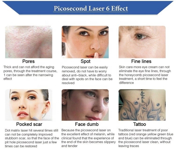 755nm 532nm picolaser Laser Tattoo Removal Machine 1064nm Microdermabrasion Device