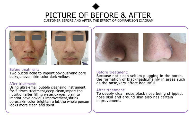 first generation smart pro skin jet dermabrasion hydro oxygen ella aqua peeling facial machine