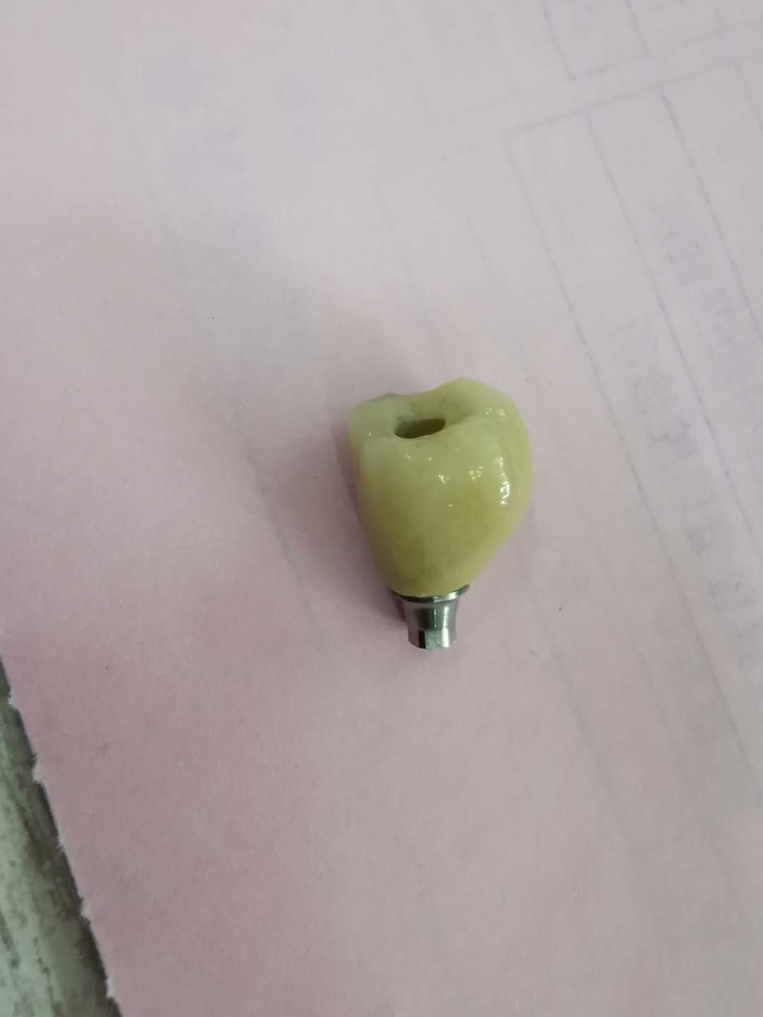 Cemented Implants Crowns Bridges