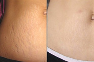 Skin Rejuvenation RF Microneedling Machine Face Lift Wrinkle Remover