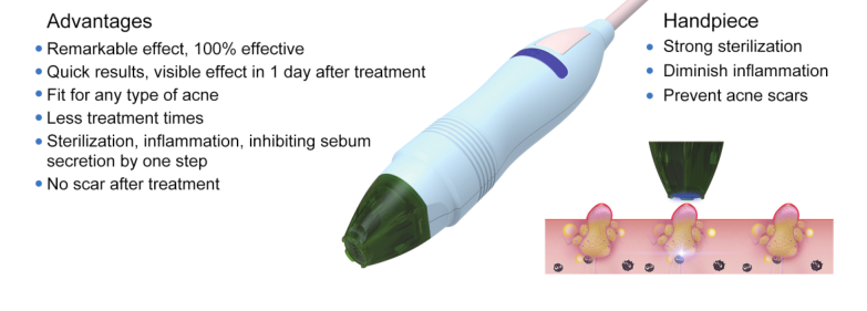 380V Laser Acne Treatment Devices Targeted Therapies For Facial Skin Cure Beauty