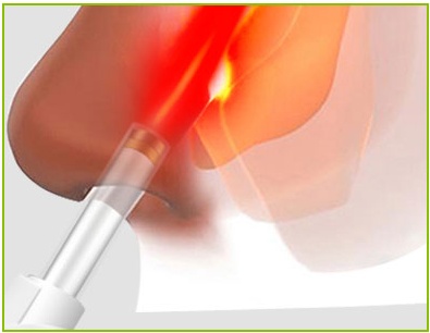 LLLT Headache Treatment Nasal Laser Therapy Device Chronic Rhinitis Therapy Device