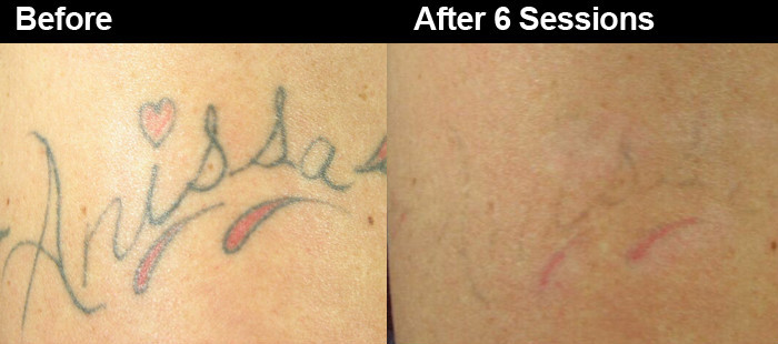 Professional q switched nd yag laser tattoo removal machine with CE approved 1064nm/532nm