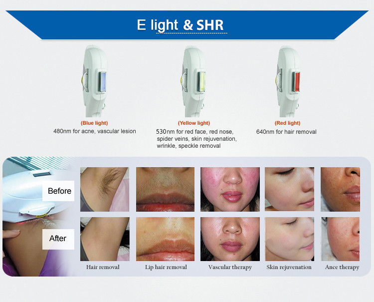 Renlang bipolar RF OPT Laser Hair Removal Machine For Skin Treatment