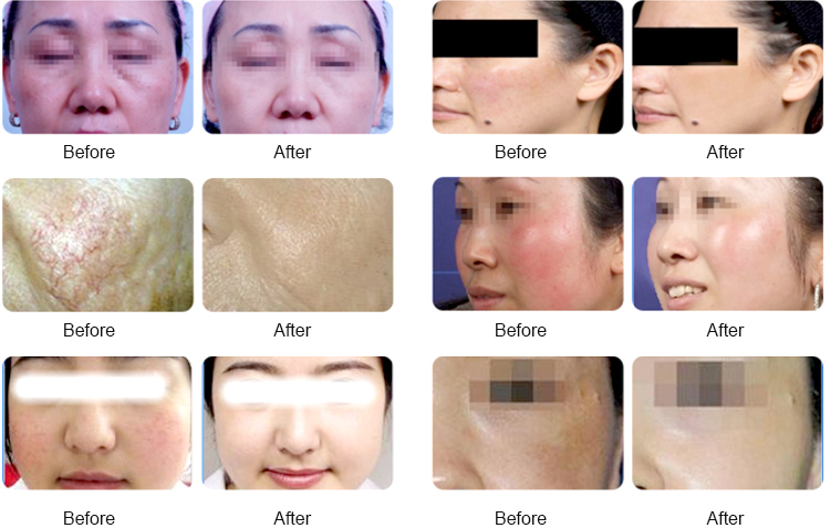 Lasertell Spider Vein Removal Machine 980nm Diode Laser