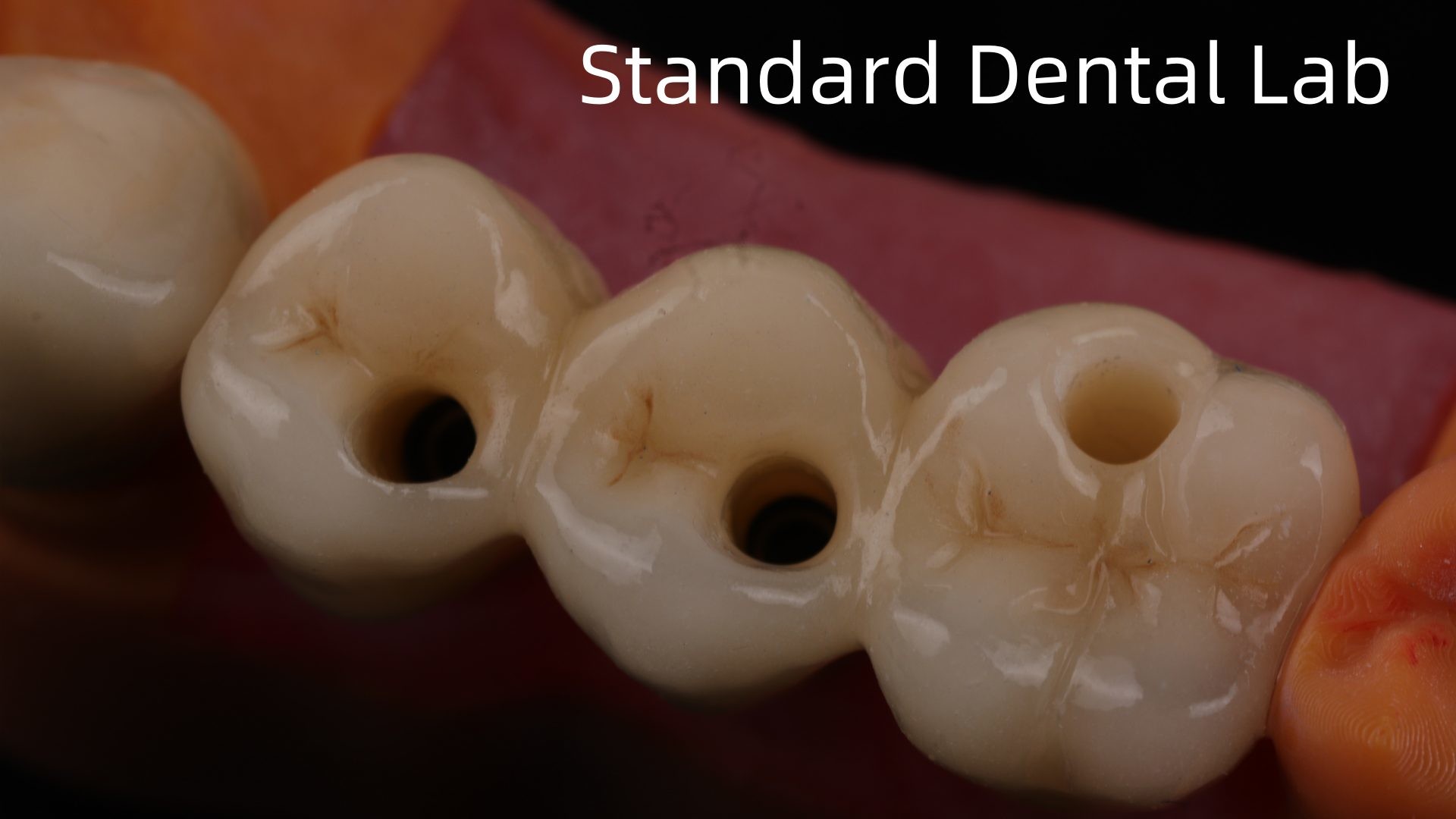 Professional Zirconia Dental Implant Crown Titanium CAD CAM Zirconia Crown China Dental Lab