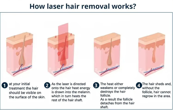 Portable IPL Machines Pores Removal For Body And Face IPL Laser Hair Removal
