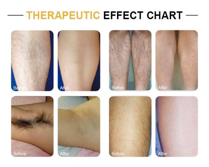 Painless 600W 808nm Diode Laser Hair Removal Germany