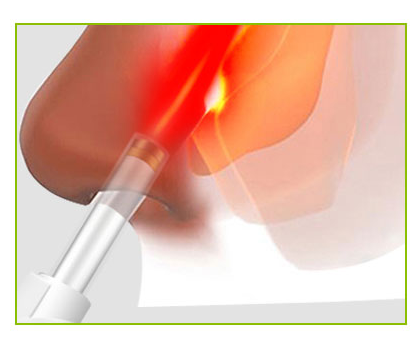 5min To 60min Portable Rhinitis Laser Therapy Device Class II Nostril Therapy Device