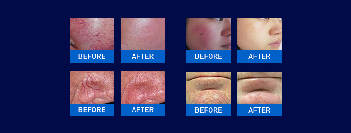 Professional 30W Spider Vein Removal 980nm Diode Laser Vascular Laser Machine Diode Laser 980nm