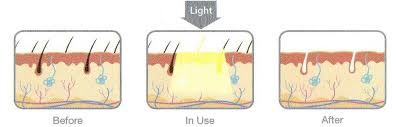 Stable Micro 808nm Laser Beam Diode Bar For Hair Removal / Skin Rejuvenation