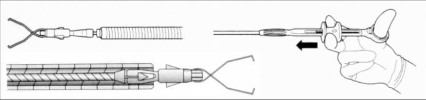 GM-HD 13mm Endoscopic Hhaemostatic Clamp Stainless Steel