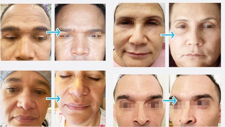 Antiaging Cross Linked Hyaluronic Acid Filler Needle Injection