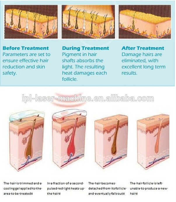 permanent hair removal portable salon use IPL SHR laser hair removal machine price