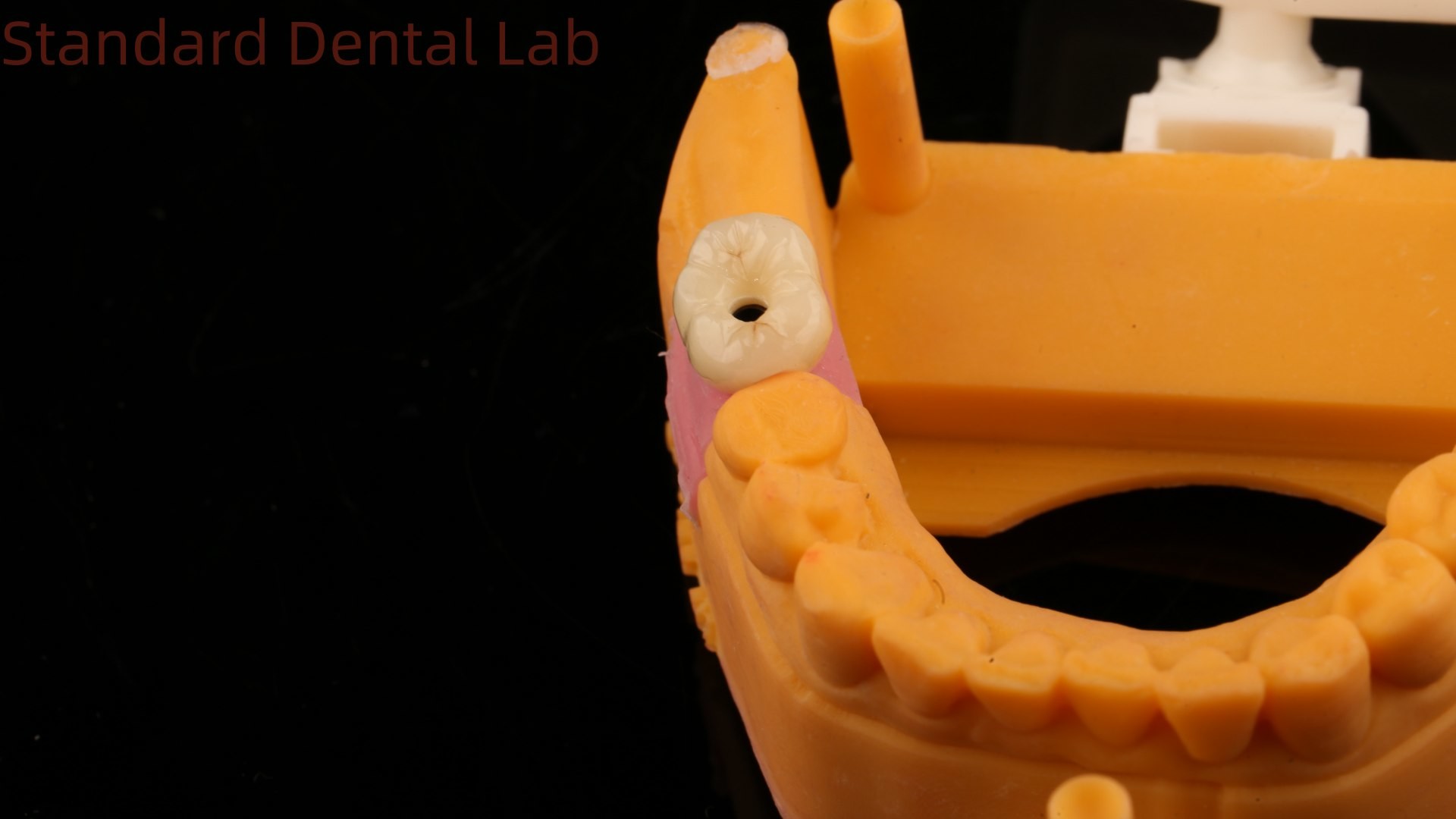 Dental Implant Screw Retained Crown PFZ Porcelain Layered Zirconia With 3D Print Model