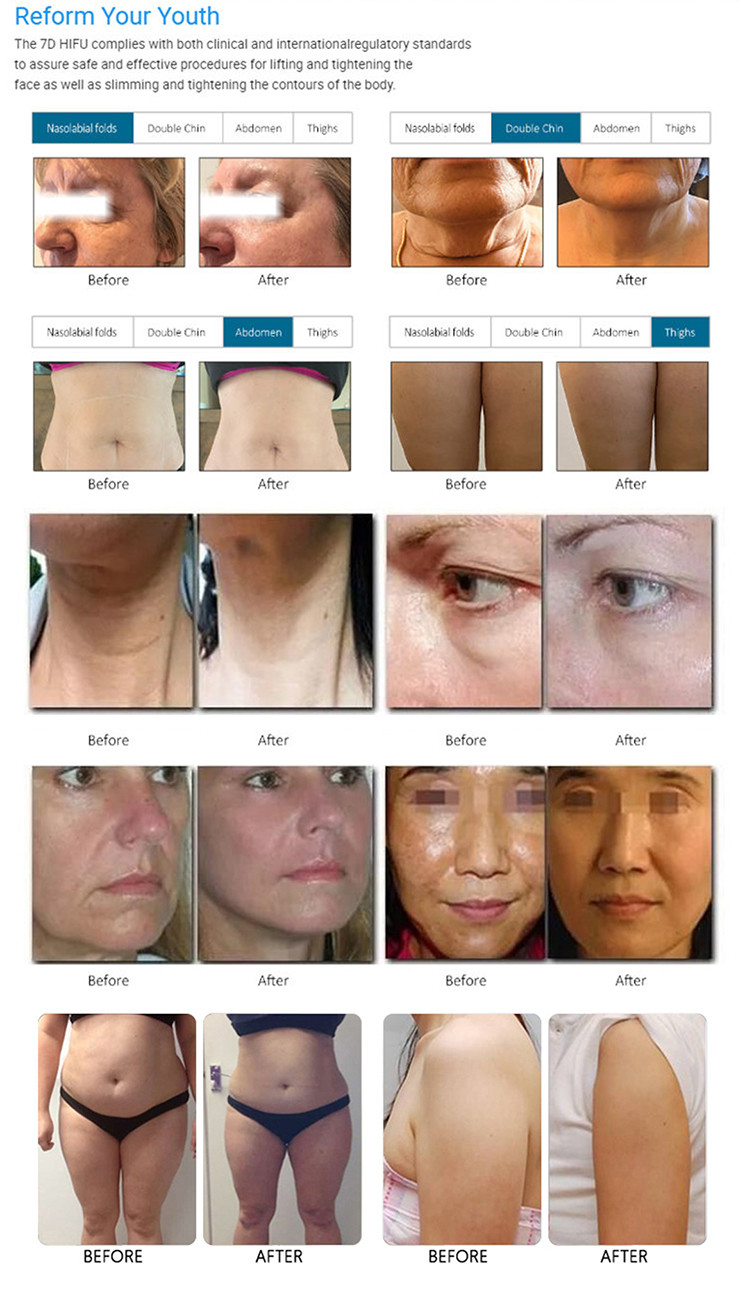 Newest 7D Hifu Beauty Machine For Whitening, Wrinkle Removal Skin Rejuvenation