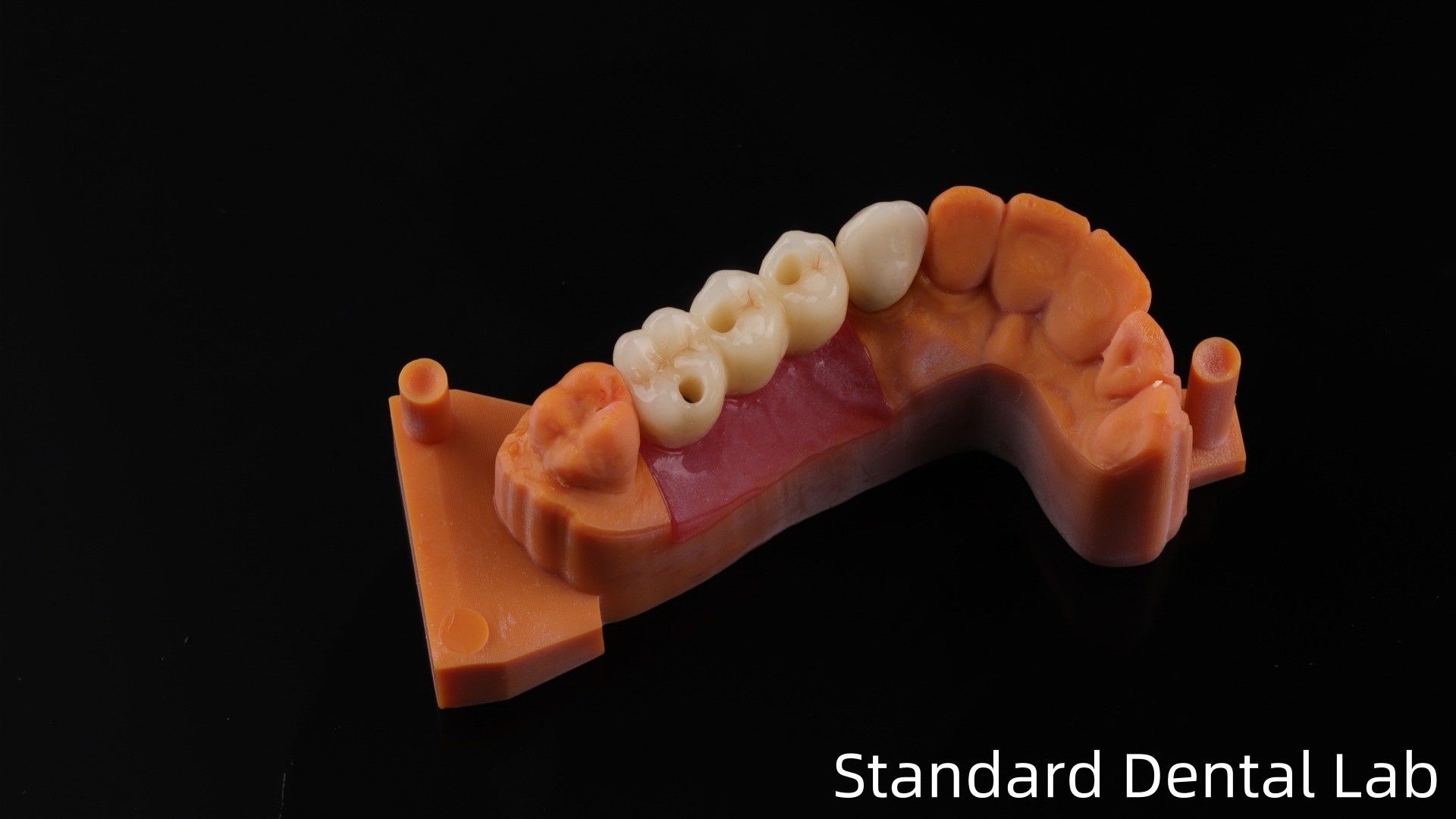 Post Core Dental Lab from China / Metal Post Core with PFM Crown
