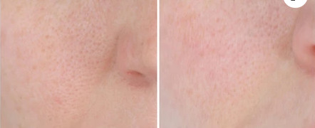 Oily Youth Serum Injection ‏Oil Control Mesotherapy Skin Treatment