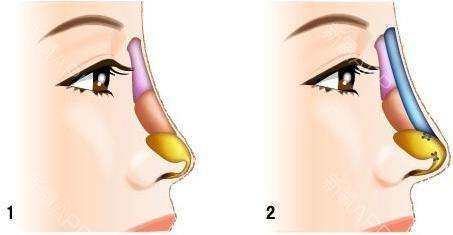 Hyaluronic Acid Injection Nose Dermal Filler , Hyaluronic Acid Gel Fillers