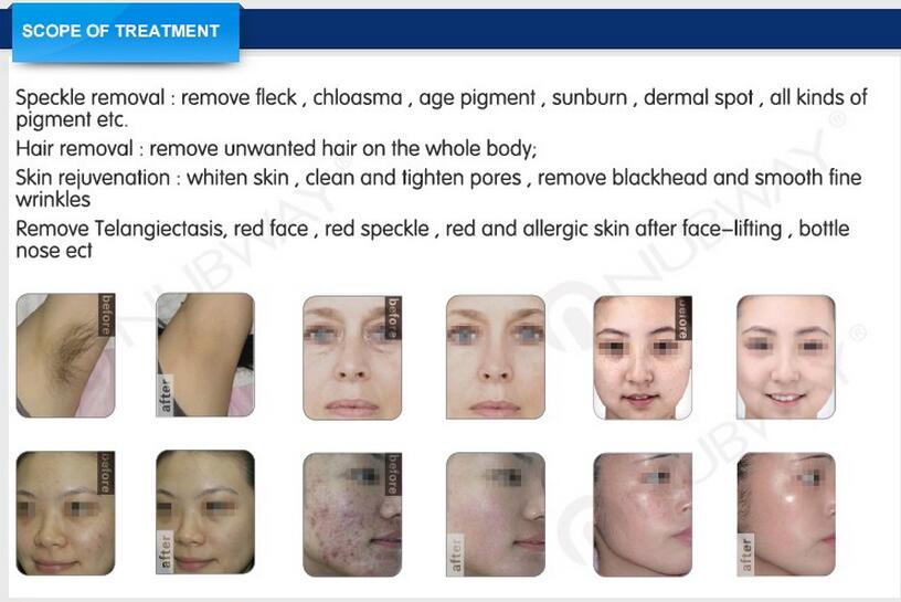 2016 new opt shr / laser hair removal machine price /Hair remover