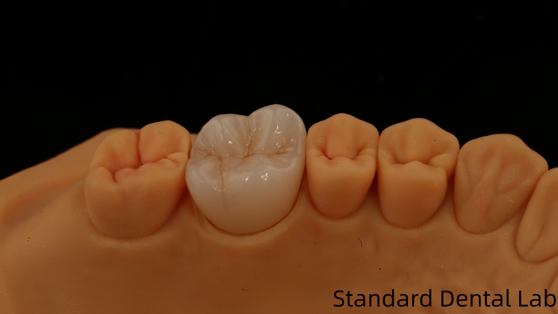 Noritake Porcelain Full Contour Zirconia Crown Customized Vita Shade for Esthetic Digital Dental Restoration by Dental Lab