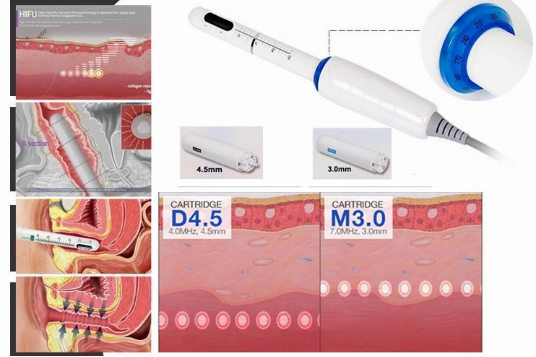 Multifunctional HIFU Machine For Vagina Tightening And V-Line Lifting