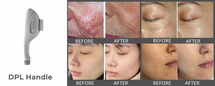 4h Diode Laser Hair Removal Equipment Design Oem Odm