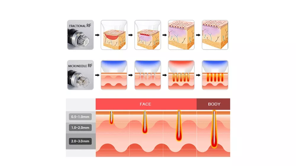 Skin Care Face Lifting RF Microneedling Fractional RF Microneedle Machine