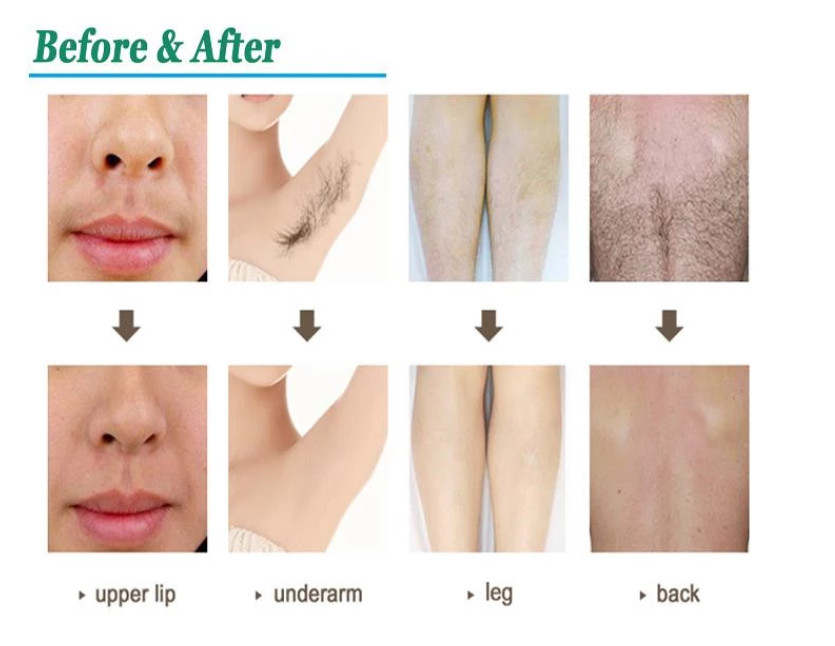 808nm Yag Hair Removal Machine