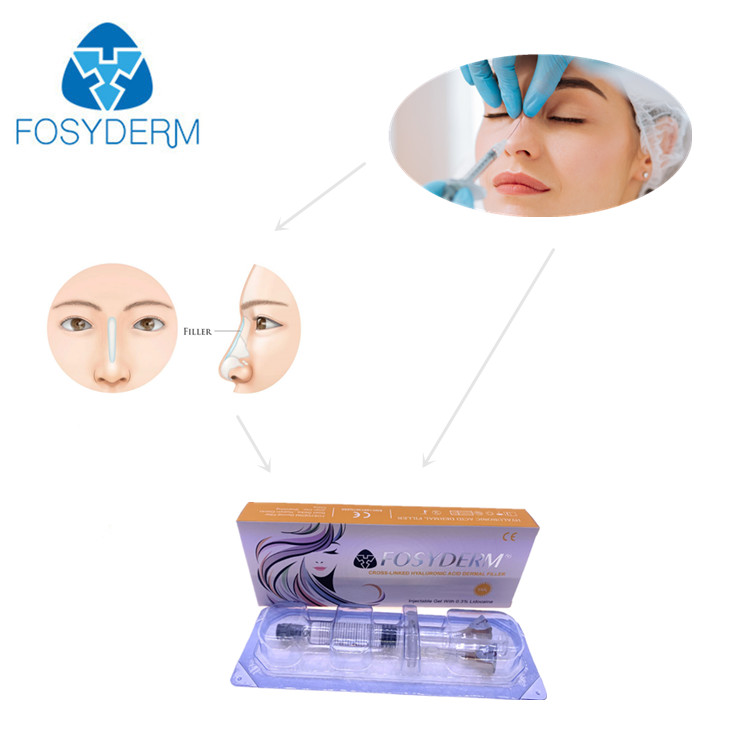 5ml Fosyderm Hyaluronic Acid Dermal Filler For Deep Lines Nose Chin Cheeks