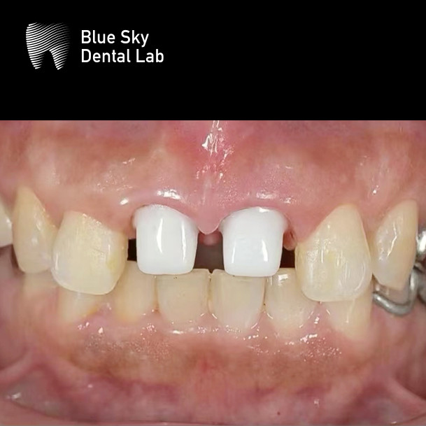 Aesthetic Zirconia Abutment Implant Biocompatible Precision Milled