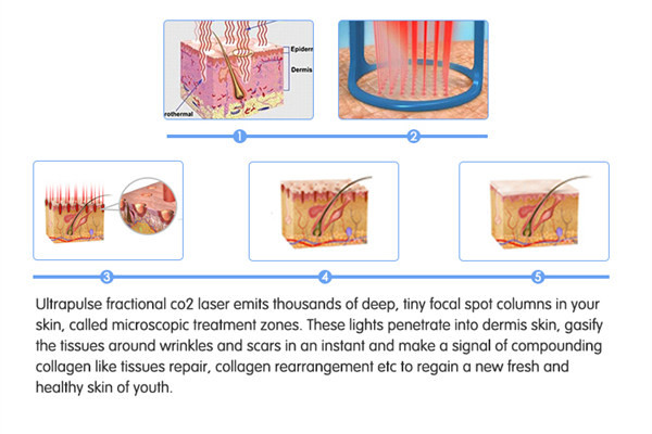 Skin Tightening Co2 Laser Treatment Machine 110V-250V