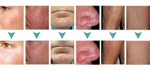 Varicose veins laser treatment machine spider veins on face removal vein removal in legs