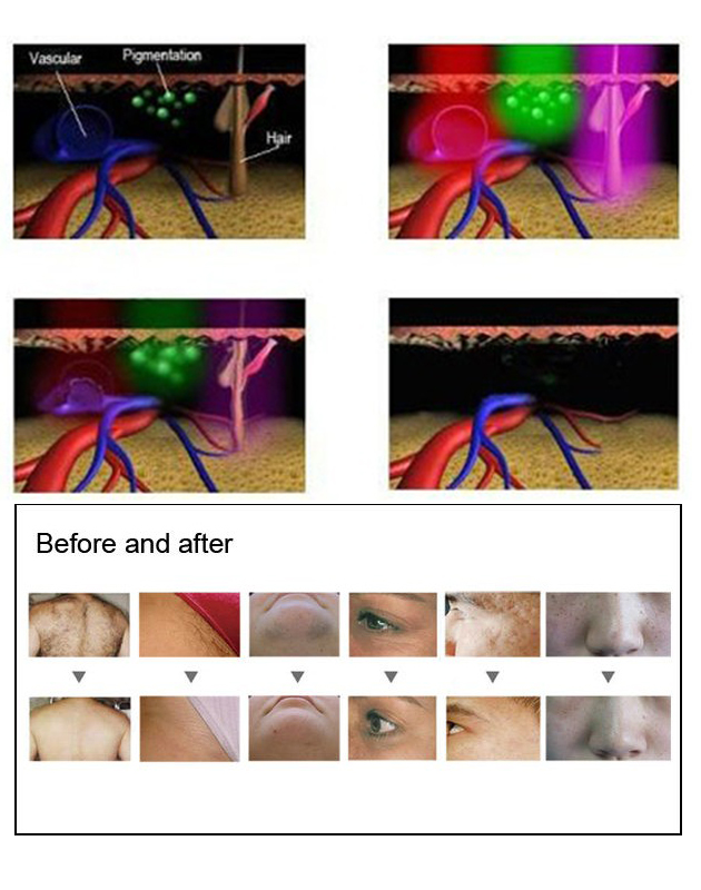 IPL OPT Diode Laser Hair Removal Equipment 480NM SHR Home Use Beauty Machine
