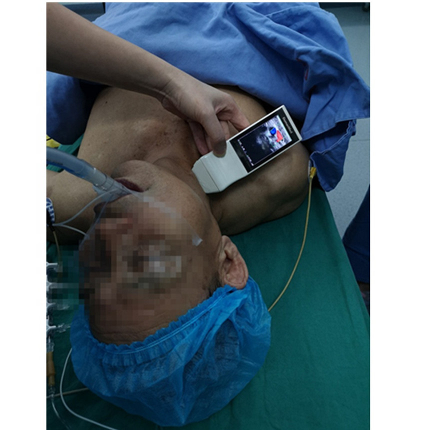 Wireless Ultrasound Tranducer Android Color Doppler Ultrasound Probe Wireless Charging