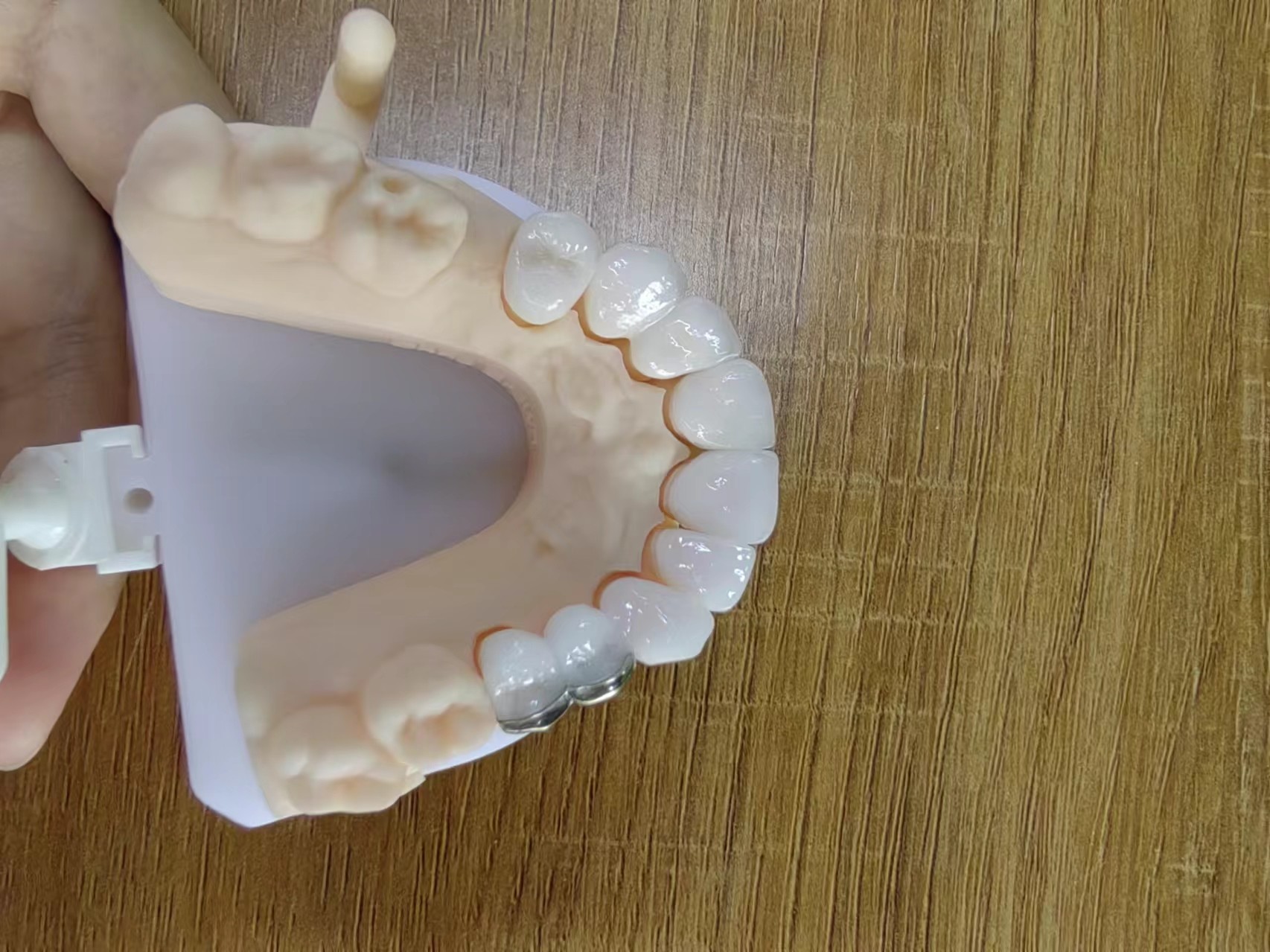 Highly Translucent Zirconia Crowns Bridge Veneers With Customized Jewelry And Gold Beautiful Dental Restoration Case