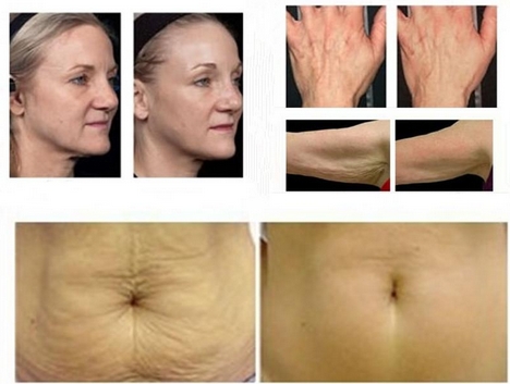 Factory Thermagic skin treatment machine microneedle rf fractional for sale