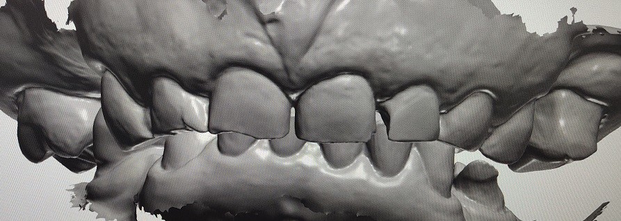 3D Digital Mock Up Teeth Other Dental Products