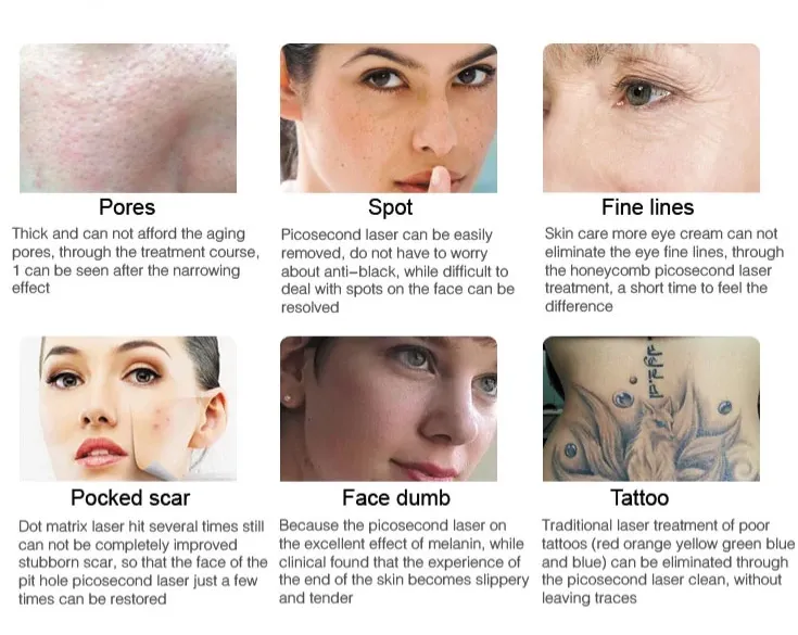 Picosecond Laser Nd Yag Laser 1064/532/755/1320Nm Tattoo Removal Skin Rejuvenation Remove Freckles/Sunspots