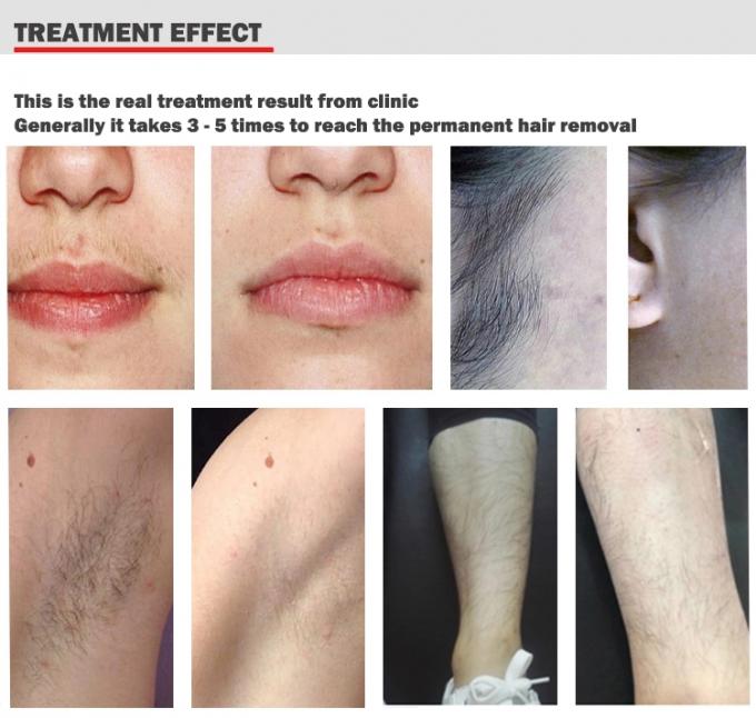 1200W High Power Diode Laser Hair Removal Machine Without The Risk Of Injury