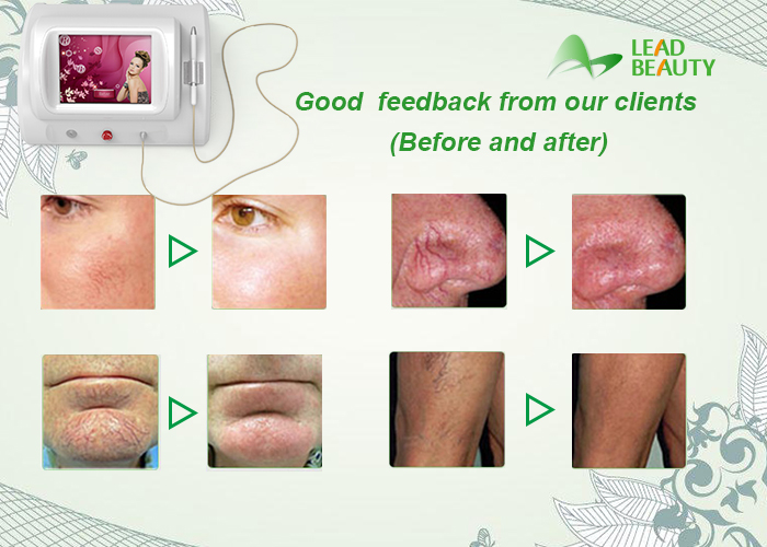 Portable style skin treatment machine for spider vein and skin tag removal 30Mhz high frequency
