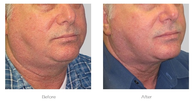 Elite Ultra 360_Before_and_After_Neck